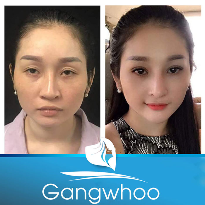 Images of our customers before & after Korean Blepharoplasty