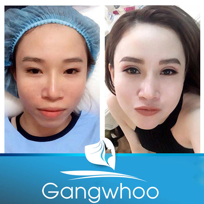 Images of our customers before & after Korean Blepharoplasty