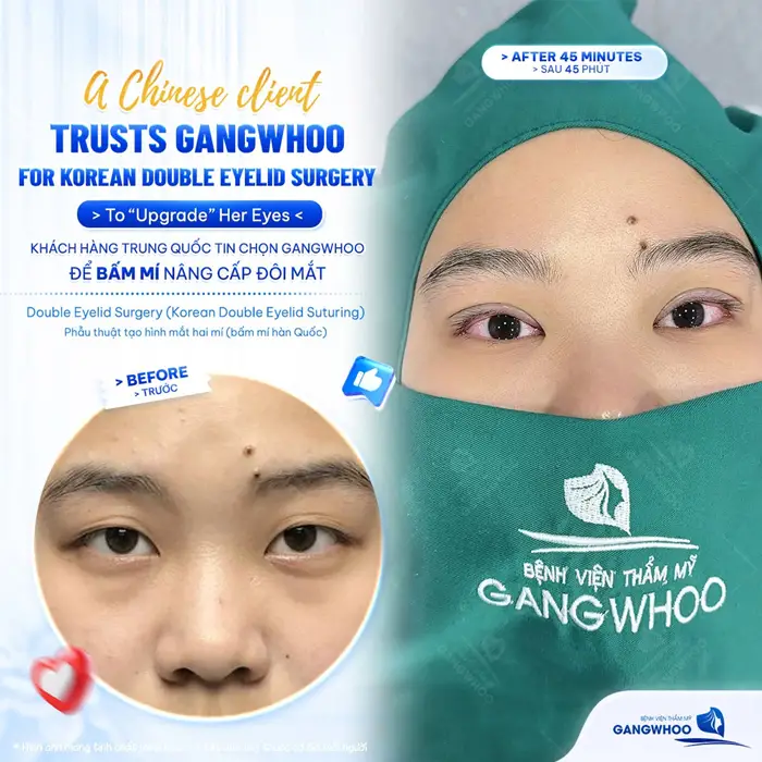 Khách Trung Quốc thực hiện bấm mí tại Gangwhoo nâng cấp ánh nhìn cho đôi mắt thêm xinh đẹp và rạng rỡ