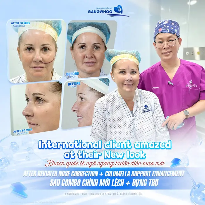 Khách quốc tế ngỡ ngàng trước diện mạo mới sau combo chỉnh mũi lệch và dựng trụ mũi