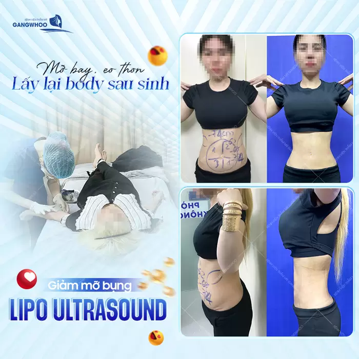 Công Nghệ Giảm Mỡ Hàng Đầu, Đánh Bay Mỡ Thừa Hiệu Quả 