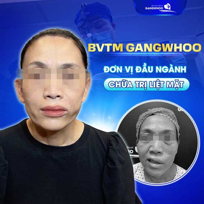 BVTM Gangwhoo - Đơn vị đầu ngành về chữa liệt mặt