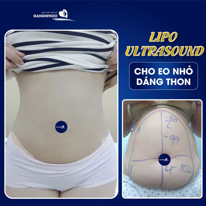 lipo ultrasound 1