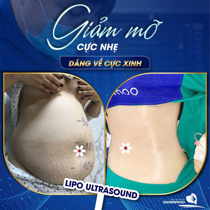 lipo ultrasound 10