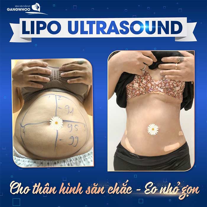 lipo ultrasound 4