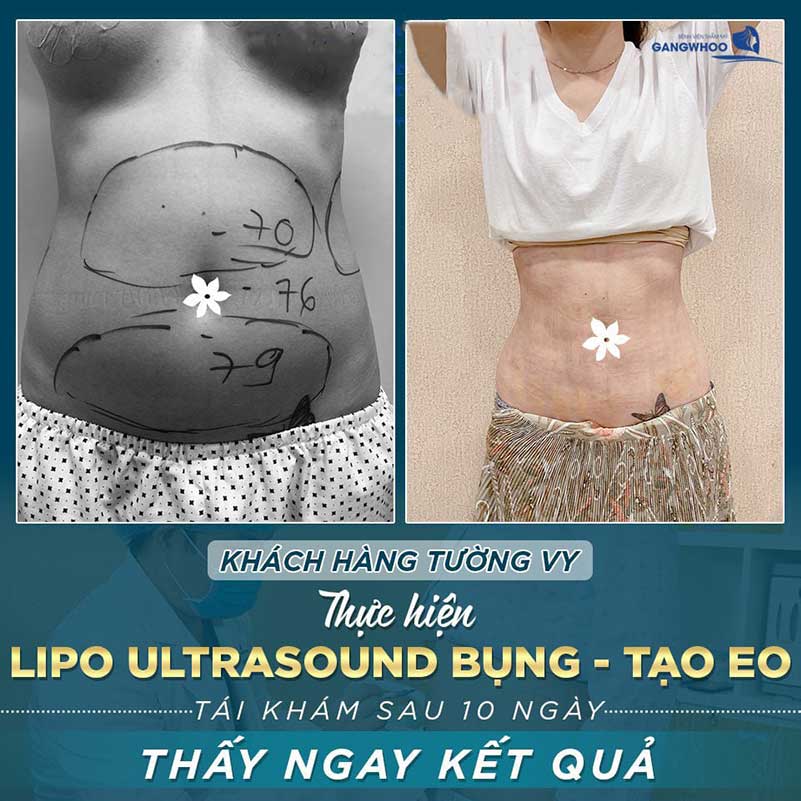 Khách hàng sử dụng công nghệ lipo ultrasound