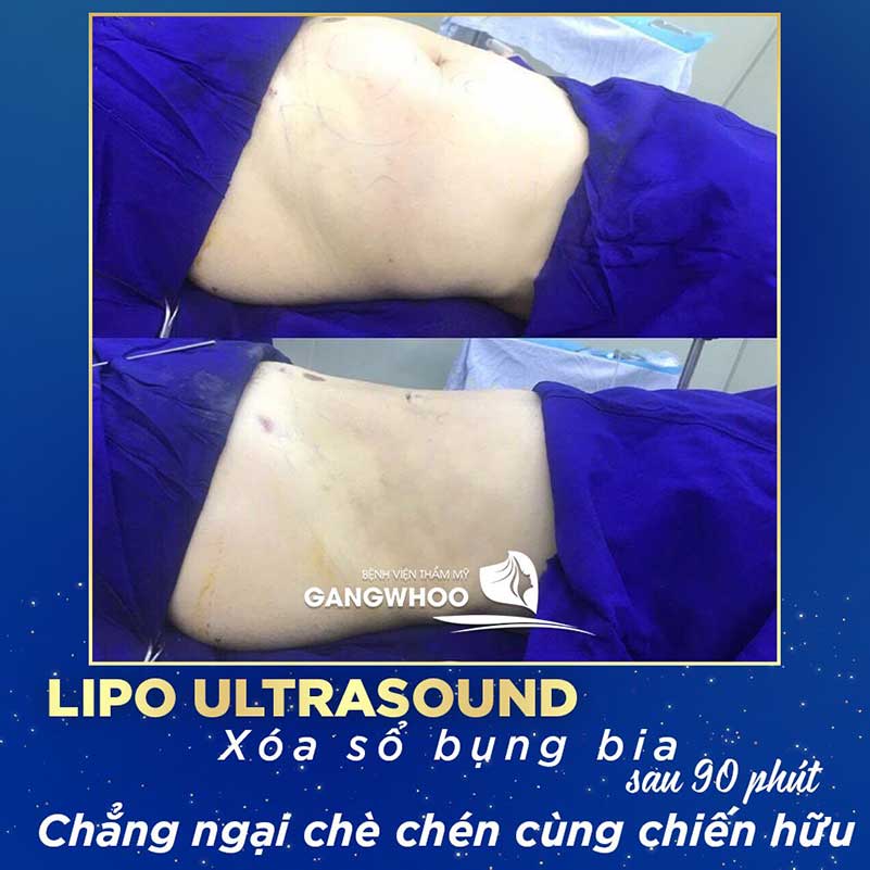 Images of our customers before & after Lipo Ultrasound