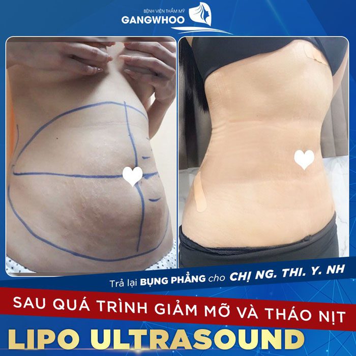 lipo ultrasound bvtm gangwhoo 1