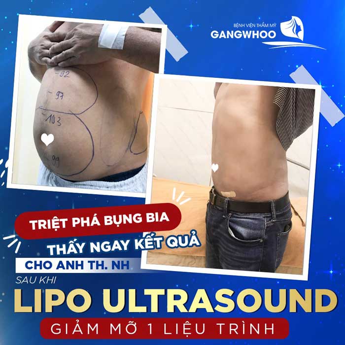 Giá Lipo Ultrasound cho nam từ 40 - 75 triệu
