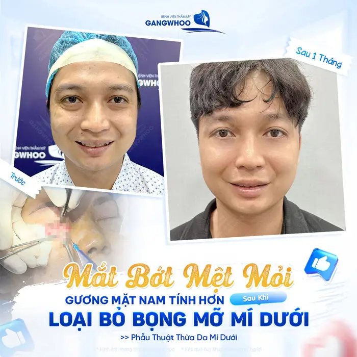 Phẫu Thuật Thừa Da Mí Dưới (Cắt Mí Dưới Perfect) Đánh Bay Bọng Mắt Da Mắt Dưới 8 Gương mặt nam tính hơn sau khi loại bỏ bọng mỡ mí dưới cải thiện khuyết điểm tăng nét đẹp tươi tắn cho ánh nhìn