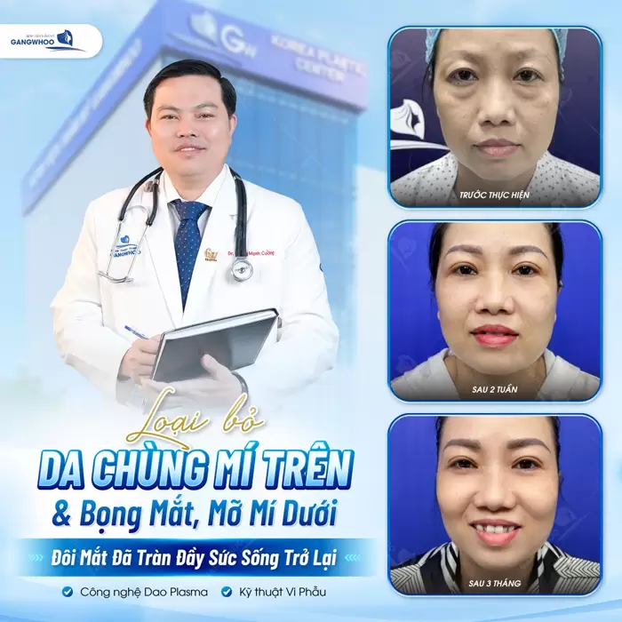 Xử lý da chùng qua đường chân mày trả lại đôi mắt đẹp trẻ trung và rạng rỡ