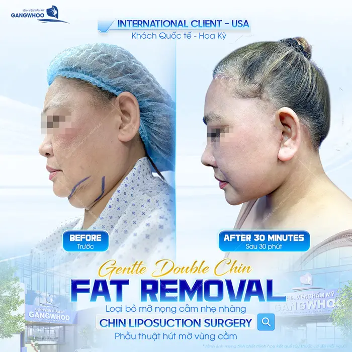 Hút Mỡ Cằm Thổi Bay 99% Nọng Mỡ Tích Cằm Hiệu Quả 15 Phẫu thuật hút mỡ vùng cằm loại bỏ mỡ cằm nhẹ nhàng, không lo nguy hiểm