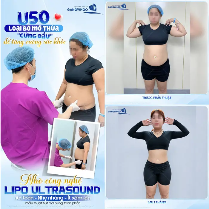 Hút Mỡ Toàn Thân An Toàn, Không Biến Chứng, Hiệu Quả Cao 22 U50 loại bỏ mỡ thừa thành công để tăng cường sức khỏe nhờ giảm mỡ bụng công nghệ Lipo Ultrasound