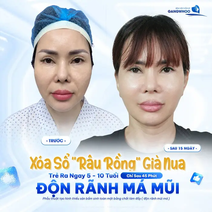 Xóa bỏ "râu rồng" già nua trẻ ngay ra 5 tuổi sau độn rãnh mũi má tại Gangwhoo