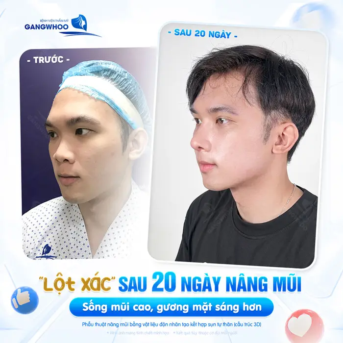 Lột xác diện mạo sau 20 ngày nâng mũi sống mũi cao, gương mặt bừng sáng sau thực hiện