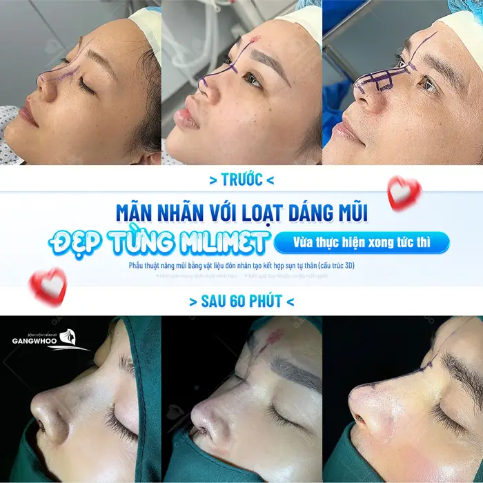 Mãn nhãn với hàng loạt dáng mũi Hàn Quốc đẹp chuẩn vừa thực hiện xong tức thì tại bệnh viện thẩm mỹ Gangwhoo 