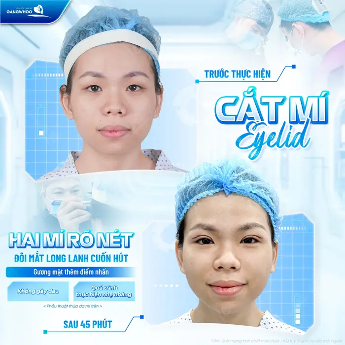 2 mí rõ nét đôi mắt long lanh đẹp cuốn hút chỉ sau 45 phút nhan sắc thăng hạng đầy cuốn hút và rạng rỡ vượt ngoài mong đợi 