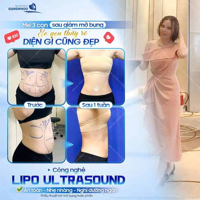 Mẹ 3 con sau giảm mỡ bụng eo thon đẹp thấy rõ diện gì cũng đẹp chỉ 1 tuần eo đã thon gọn tức thì 
