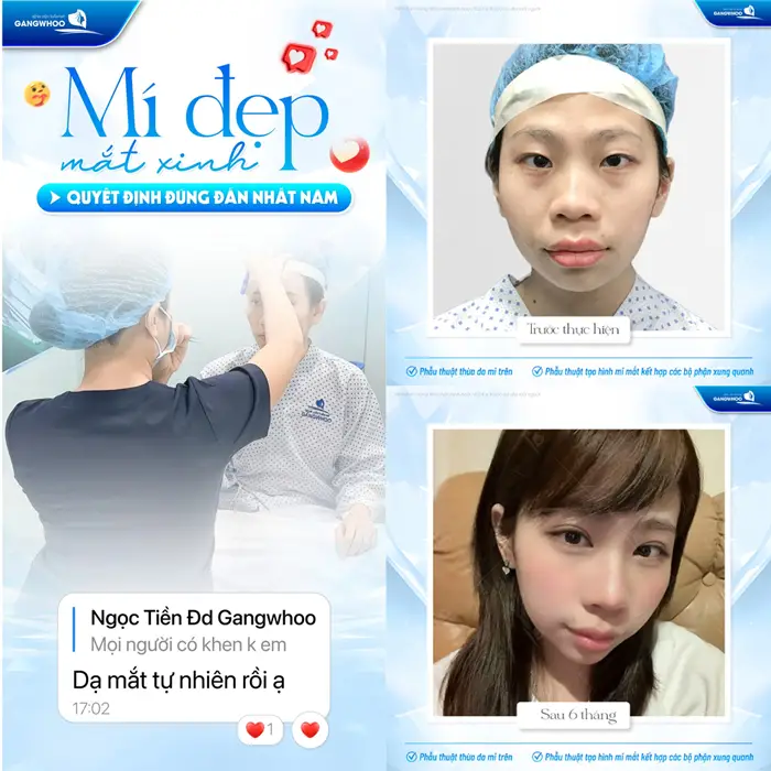mi dep mat xinh quyet dinh dung dang nhat nam sau phau thuat cat mi