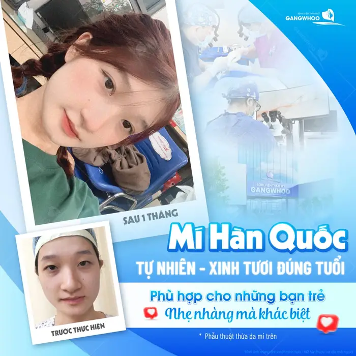 Cắt Mí Hàn Quốc Cho Bạn Đôi Mắt 2 Mí Đẹp Chuẩn "Sao Hàn" 4 Cắt mí Hàn Quốc mắt đẹpt ự nhiên xinh tươi đúng tuổi phù hợp cho bạn trẻ muốn đẹp nhẹ nhàng mà khác biệt