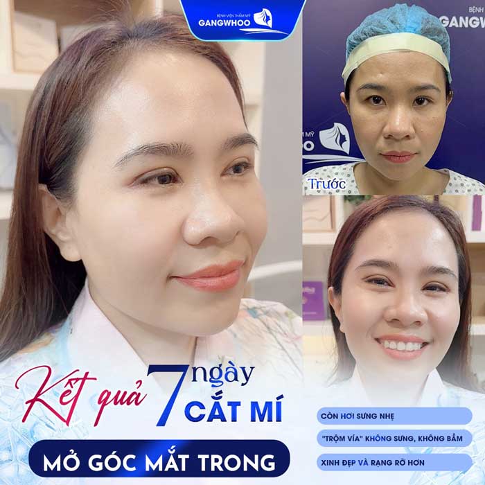 Mắt Phượng Là Gì? Tướng Số Tốt Không? Cách Sở Hữu Mắt Phượng? 13 Khách hàng sở hữu diện mạo xinh đẹp, hài hòa sau khi thực hiện mở góc mắt trong