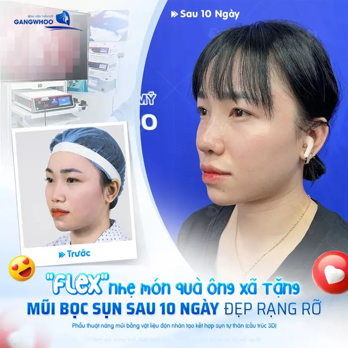 Nâng Mũi Bọc Sụn Tự Thân: Ưu Điểm Và Chi Phí Năm 2026 2 Nâng mũi bọc sụn sau 10 ngày mũi đẹp rạng rỡ, diện mạo thêm thăng hạng và tự tin hơn