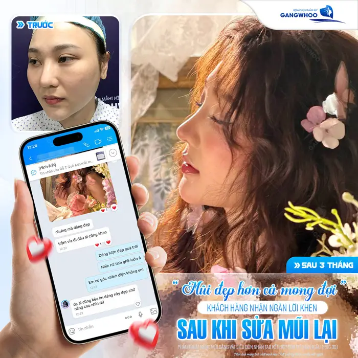 mui cao dep hon ca mong doi khach hang danh loi khen sau phau thuat nang mui sua lai