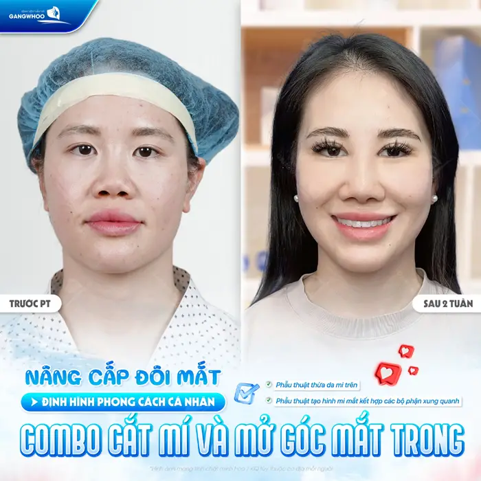 Nâng cấp đôi mắt định hình phong cách cá nhân với combo cắt mí và mở góc mắt trong 