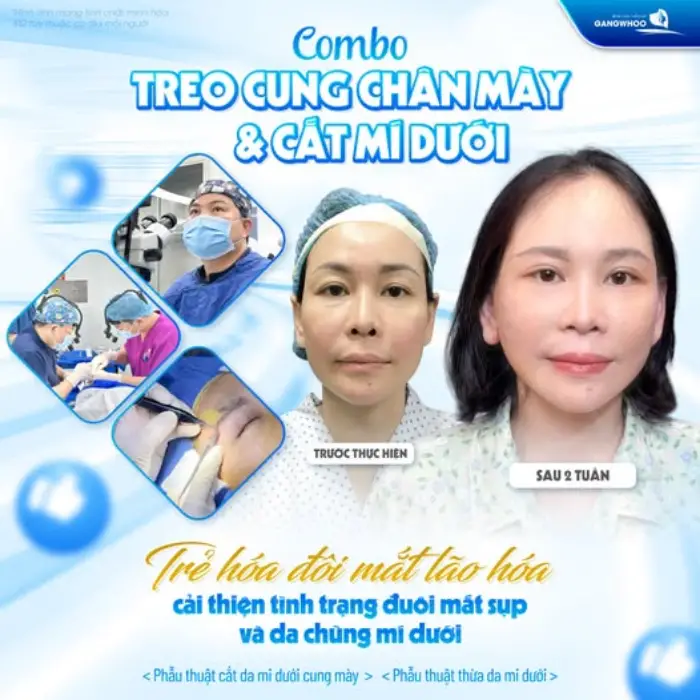 Treo cung chân mày trẻ hóa mắt, xóa bỏ da chùng sụp mí cho khách hàng trung niên