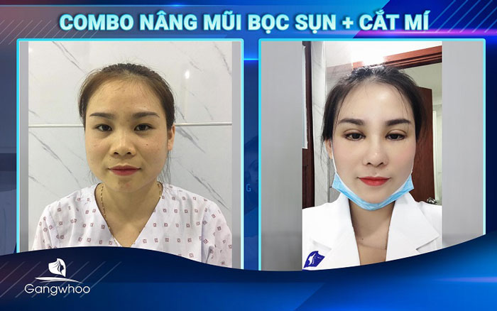 Hình ảnh khách hàng nâng mũi tại bệnh viện thẩm mỹ Gangwhoo