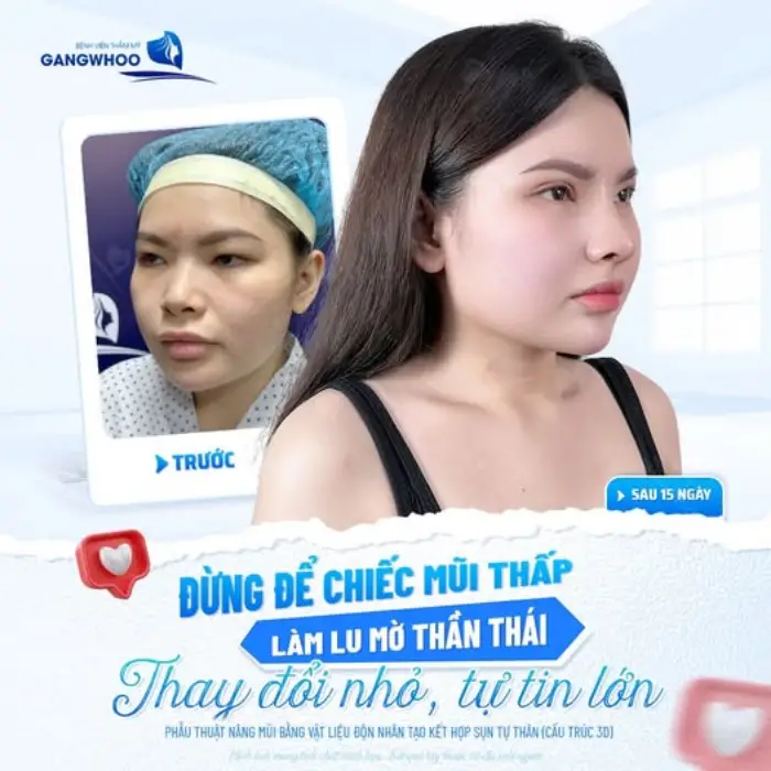 Kỹ thuật nâng mũi bọc sụn tự thân giúp bảo vệ đầu mũi, ngăn ngừa bóng đỏ và lộ sóng