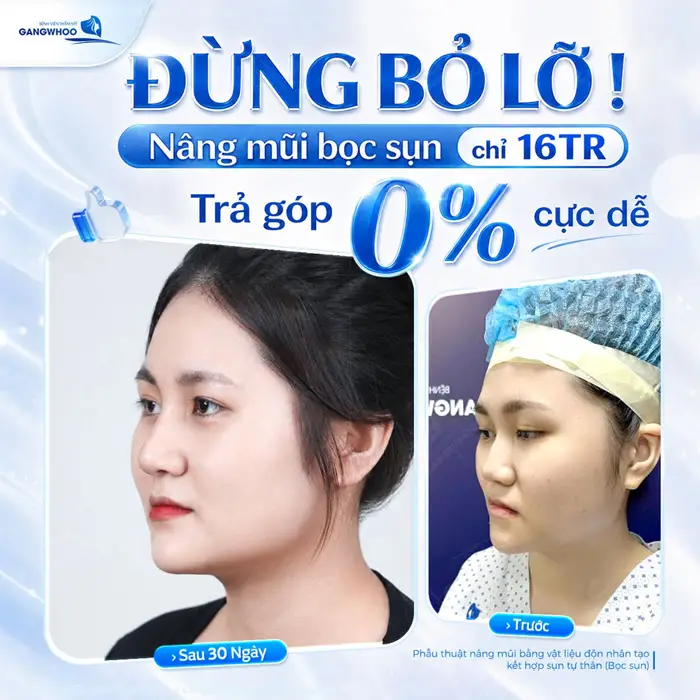 Nâng Mũi Bọc Sụn Tự Thân: Ưu Điểm Và Chi Phí Năm 2026 8 Đừng bỏ lỡ nâng mũi bọc sụn trả góp nhẹ nhàng cực linh hoạt tại bệnh viện thẩm mỹ Gangwhoo