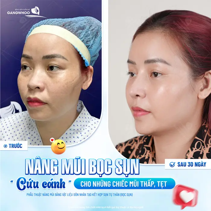 Nâng mũi bọc sụn cứu cánh cho những chiếc mũi thấp, tẹt sau 30 phút mũi đã vào form đẹp hài hòa và cân đối