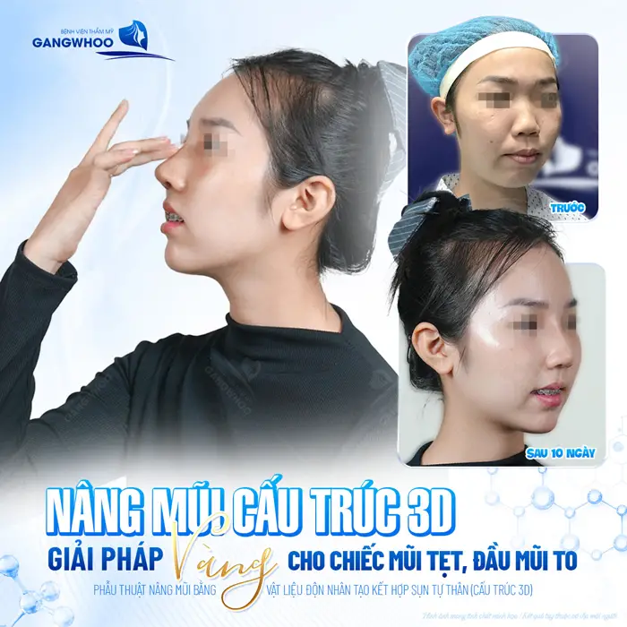 Nâng mũi cấu trúc 3D giải pháp vàng cho chiếc mũi tẹt, đầu mũi to 10 ngày đã hoàn toàn khác biệt 