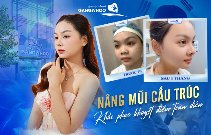 nang mui cau truc khac phuc khuyet diem toan dien