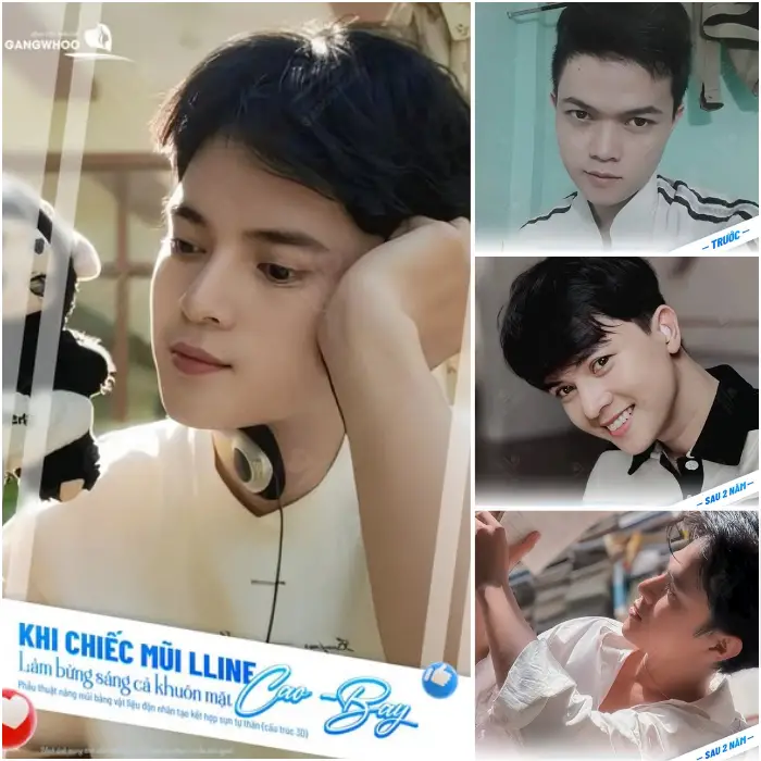 Kết quả phẩu thuật nâng mũi của khách hàng sau 2 năm 