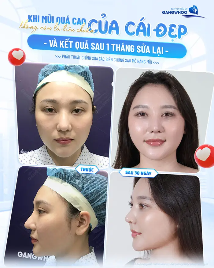 Chỉnh sửa mũi sau nâng quá cao hóa hài hòa và cân đối, tự tin khoe nhan sắc đẹp tự nhiên và mềm mại