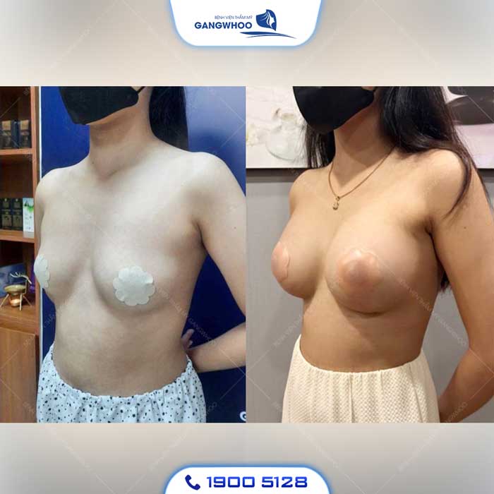Phẫu Thuật Nâng Ngực: Chỉ Định, Quy Trình Và Bảng Giá 2026 19 nang nguc 2 5