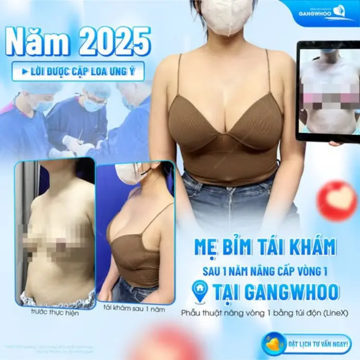Phẫu Thuật Nâng Ngực: Chỉ Định, Quy Trình Và Bảng Giá 2026 8 Kết quả 1 năm nâng ngực túi LineX: Vòng 1 mềm mại tự nhiên, form dáng chuẩn tỷ lệ vàng cho mẹ bỉm sữa
