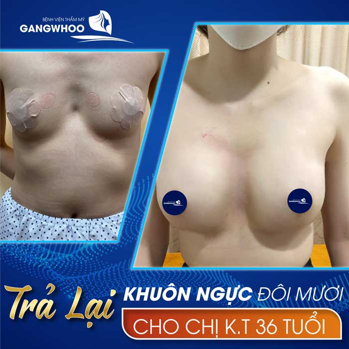Images of our customers before & after breast augmentation at Gangwhoo Cosmetic Hospital