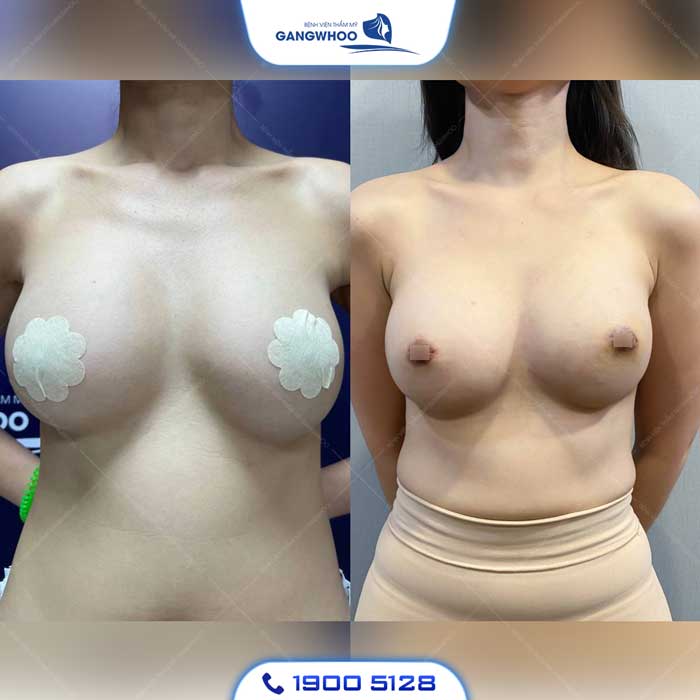 Phẫu Thuật Nâng Ngực: Chỉ Định, Quy Trình Và Bảng Giá 2026 21 nang nguc 4 3