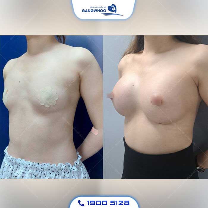 Phẫu Thuật Nâng Ngực: Chỉ Định, Quy Trình Và Bảng Giá 2026 25 nang nguc 8 1