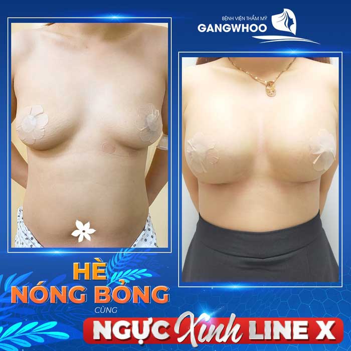 Images of our customers before & after breast augmentation at Gangwhoo Cosmetic Hospital