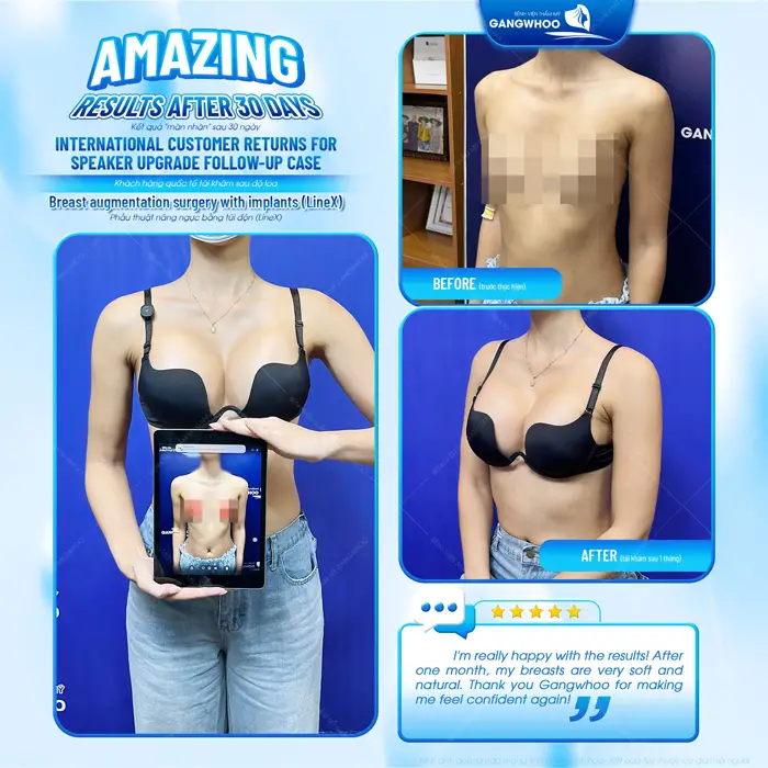 Phẫu Thuật Nâng Ngực: Chỉ Định, Quy Trình Và Bảng Giá 2026 33 nang nguc tu tin khoe vong 1 cang day duong x line dep xuat sac sau phau thuat