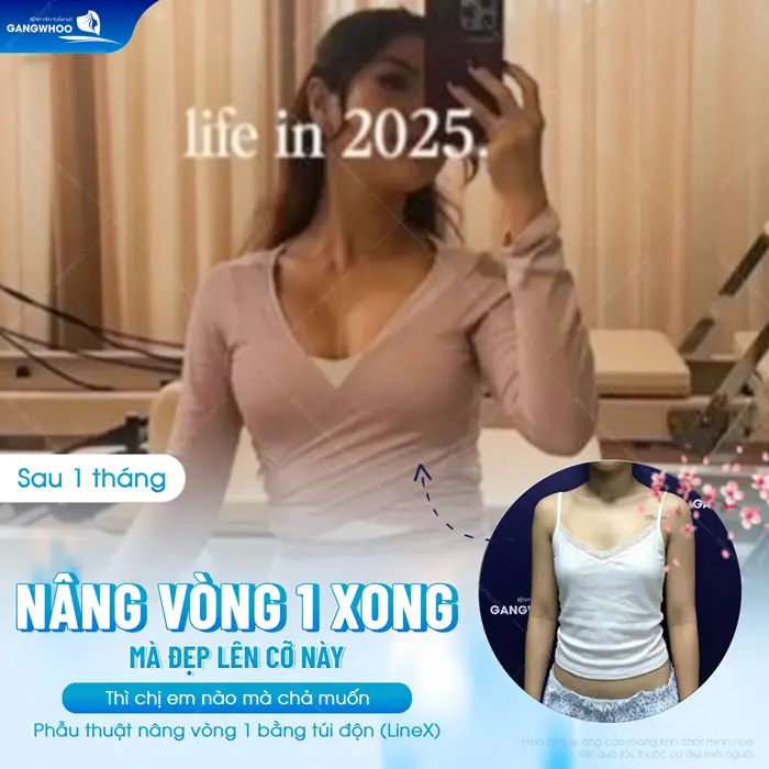 Phẫu Thuật Nâng Ngực: Chỉ Định, Quy Trình Và Bảng Giá 2026 2 nang vong 1 xong dep co nay ai cung me 1