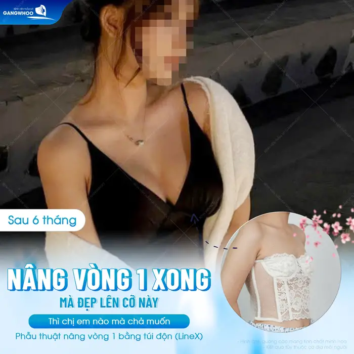 Phẫu Thuật Nâng Ngực: Chỉ Định, Quy Trình Và Bảng Giá 2026 3 nang vong 1 xong dep co nay ai cung me 2