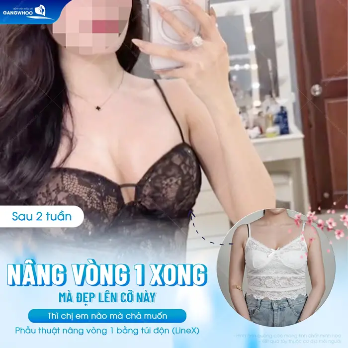 Phẫu Thuật Nâng Ngực: Chỉ Định, Quy Trình Và Bảng Giá 2026 4 nang vong 1 xong dep co nay ai cung me 3