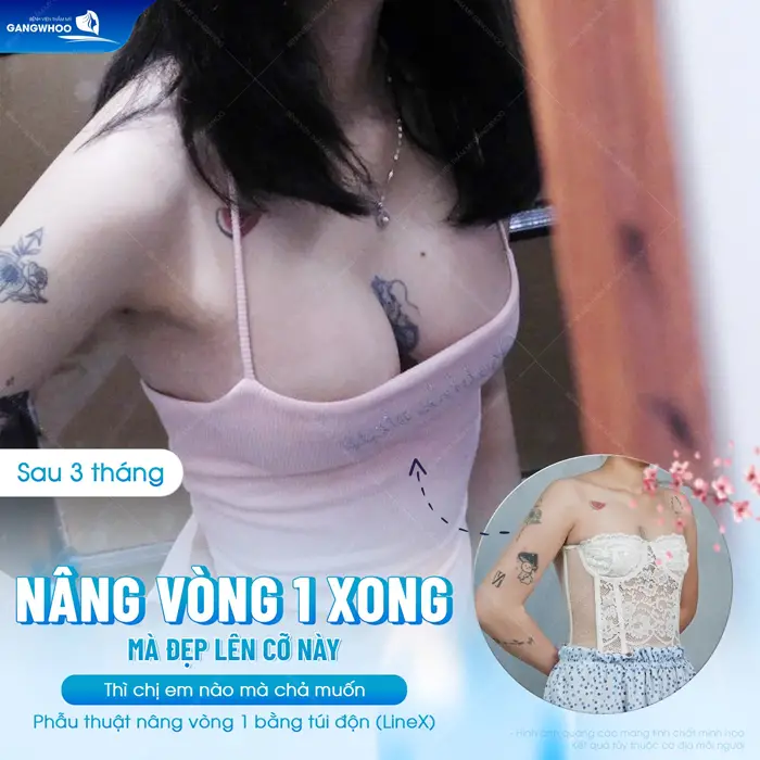 Phẫu Thuật Nâng Ngực: Chỉ Định, Quy Trình Và Bảng Giá 2026 1 nang vong 1 xong dep co nay ai cung me 4