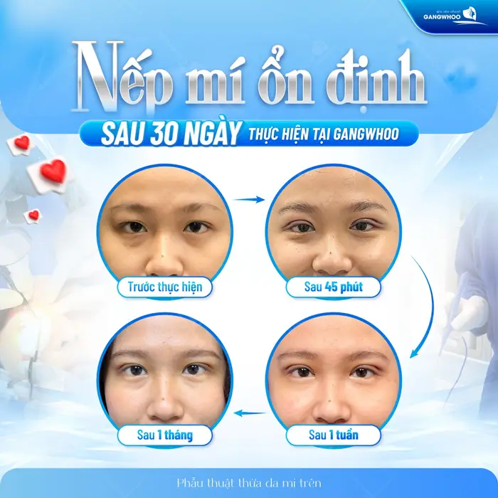 Sau 30 ngày thực hiện phẫu thuật thừa da mi trên nếp mí ổn định và lành thương