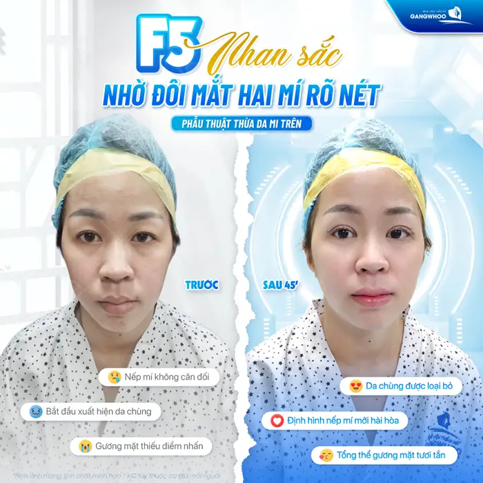 Nhan sắc thăng hạng đôi mắt 2 mí đẹp rõ nét sau 45 phút phẫu thuật đã hoàn toàn thay đổi 